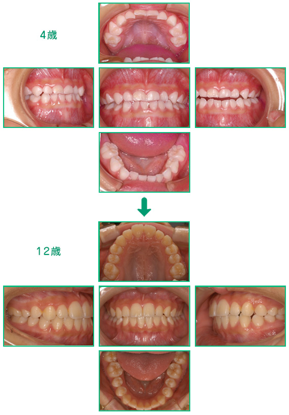 予防歯科の実践例
