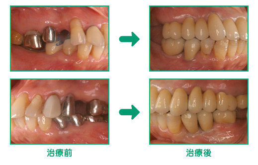 審美歯科の治療例4