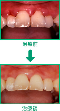 歯周病の治療例