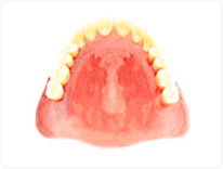 レジン床(保険診療)