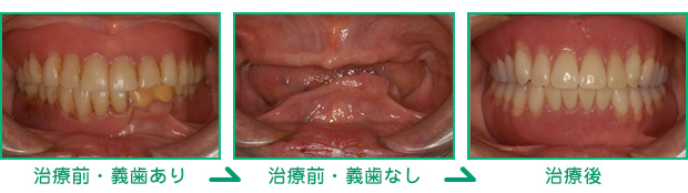 入れ歯による治療例