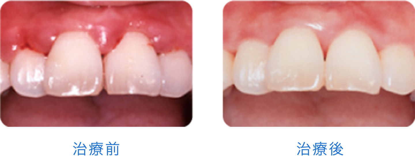 歯周病_治療比較画像