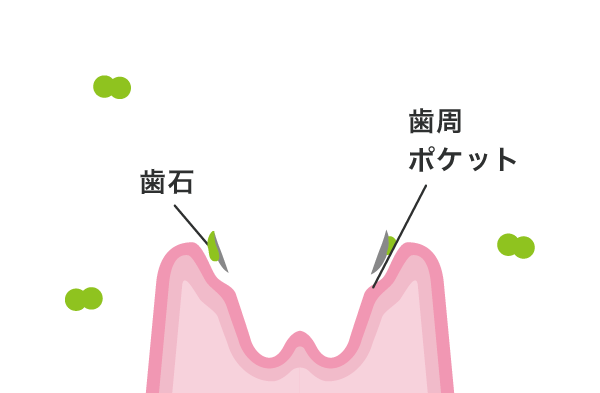 03:歯ぐきが腫れ、溝ができる