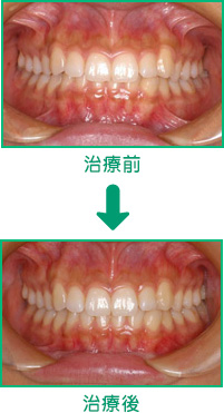 咬合治療例