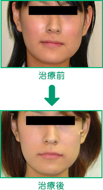 咬合治療例