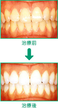ホームホワイトニング