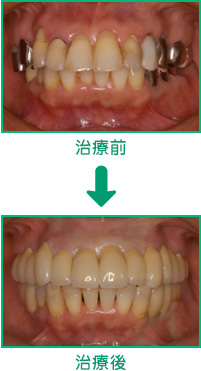 審美歯科の治療例