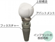 インプラント治療とは?