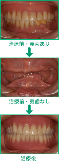 入れ歯による治療例